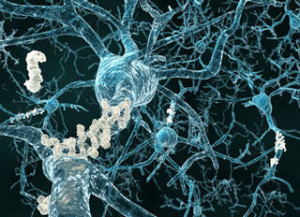 shutterstock_Alzheimers-amyloid-plaque_ml_1