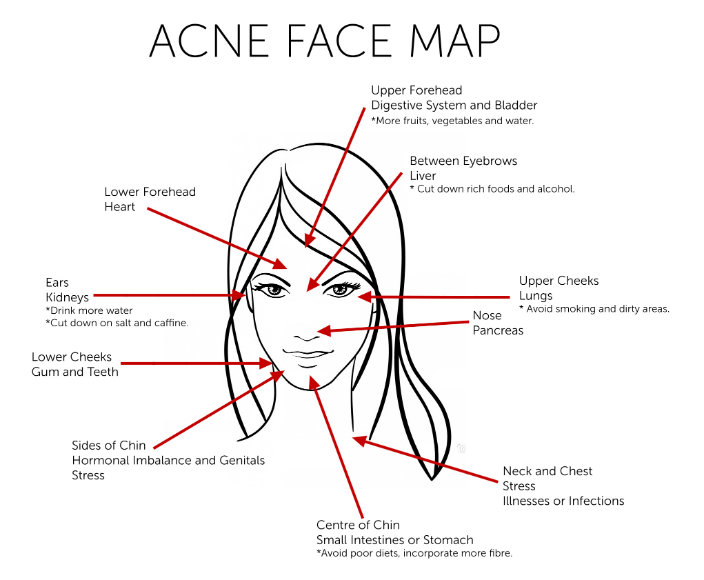 Acne can tell a lot about your health 2 source: realfarmacy