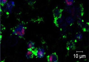 Live cell imaging shows fluorescently labeled targeted ZnO nanoparticles (green) dissolving to release zinc ions (blue) within the intracellular environment of triple-negative breast cancer cells, activating cell death pathways (red). © 2016 KAUST