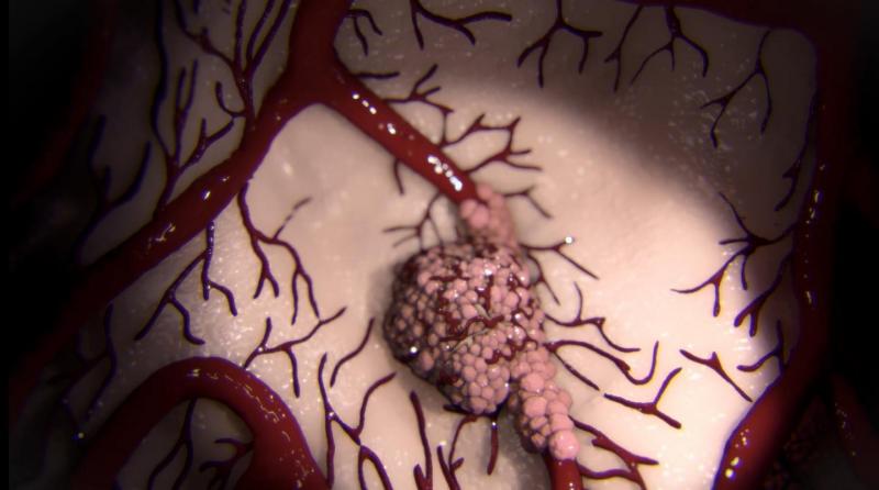Surprising Findings Reveal How Cancer Spreads in the Body 2 This metastasis animation shows the primary tumor. Source: Barts Cancer Institute, QMUL