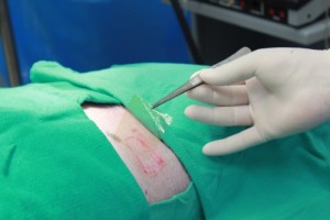 UW-Madison spinoff gets FDA OK for bacteria-killing wound dressing 4 imbed-dressing-500x334