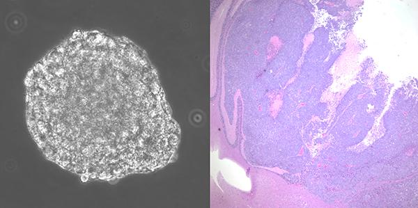 Scientists Engineer Stem Cells to Find Potential Therapy for Medulloblastoma