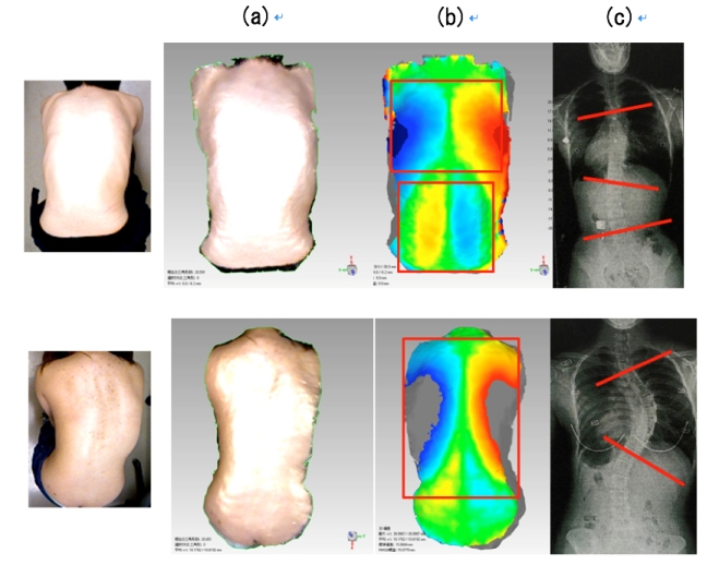 A new system to detect spinal deformity