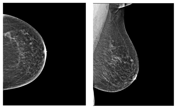 Breast Density in Quantifying Breast…