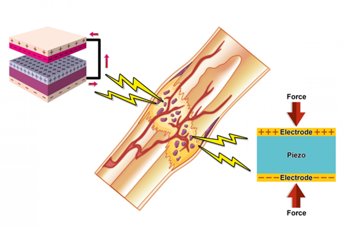 Using bone’s natural electricity to…