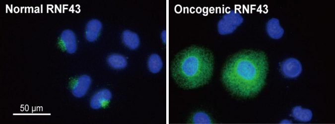 colorectal cancer