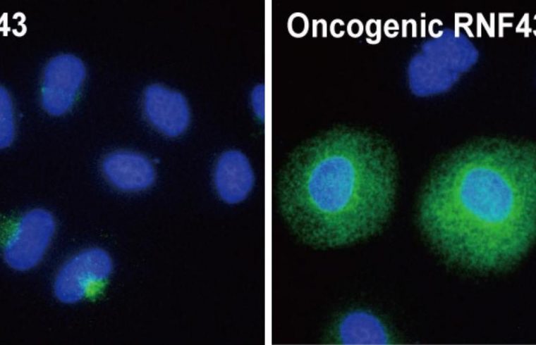 colorectal cancer