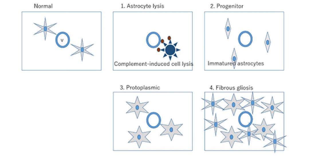 Classification Scheme Developed for Newly Identified Multiple Sclerosis-like Disease