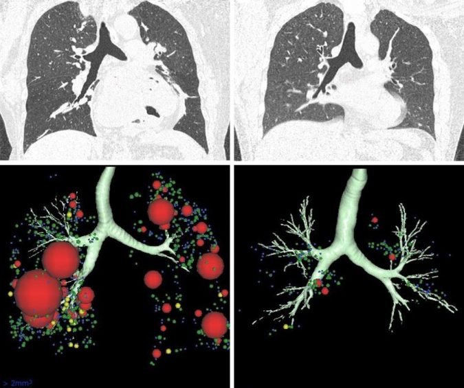 lung CT scans 3D models