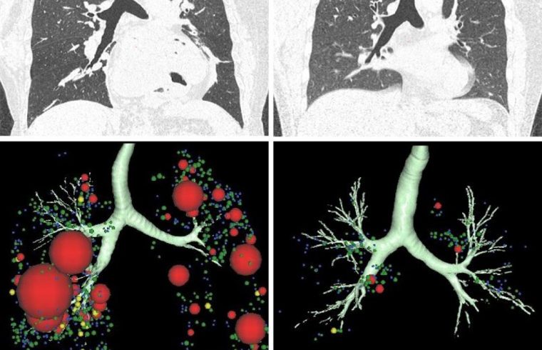 lung CT scans 3D models