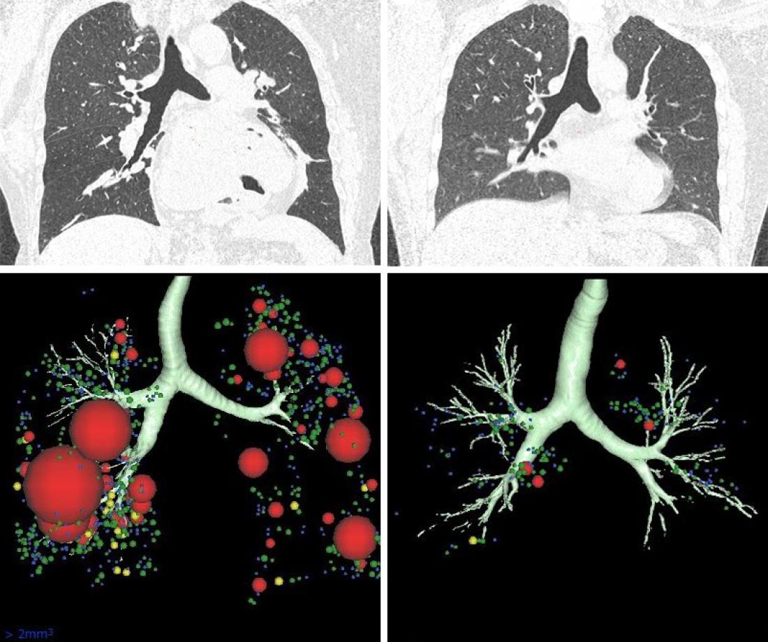 CT scans suggest possible lung…