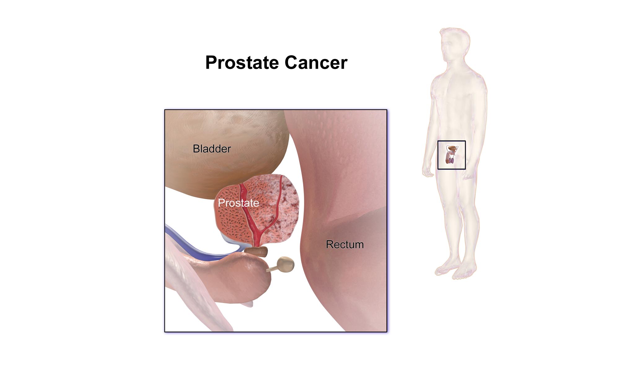 Metastatic prostate cancer comes in two forms, which could guide treatment