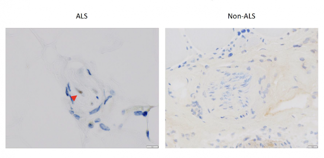 Muscle biopsy test for biomarker could lead to earlier diagnosis of ALS